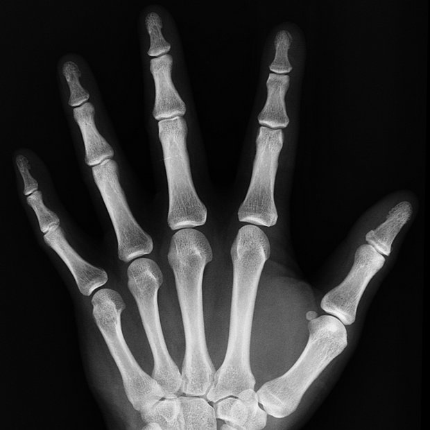 on x-ray of a hand
